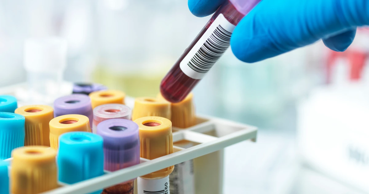 Vial of blood prepared for an apolipoprotein B cholesterol test in a clinical laboratory. Photo: NBC News