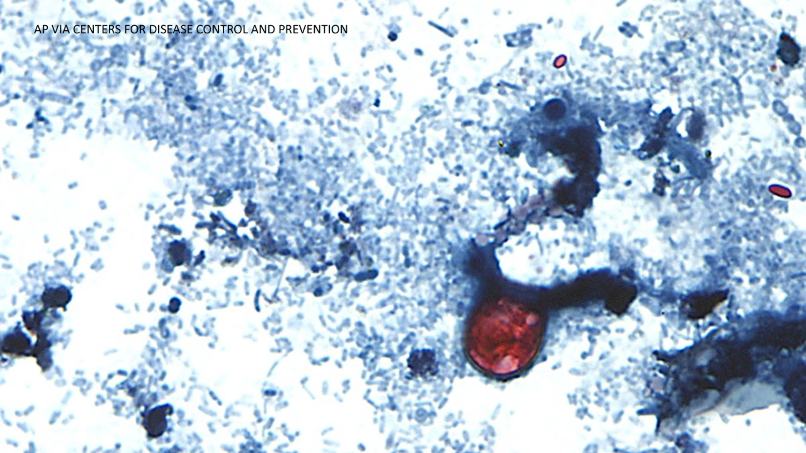 Map showing cyclosporiasis cases confirmed across more than 30 US states in summer 2026. Photo: ABC News (ABC7 New York)